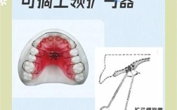 螺旋扩弓器制作方法步骤具体是怎样的？
