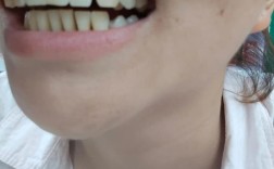 牙齿矫正后牙齿松动，是矫正过程中的正常反应吗？