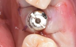 现在种植一颗牙