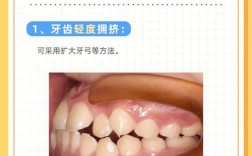 牙列拥挤可以正畸吗