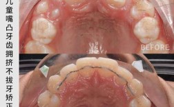 正畸后牙外展弯图片