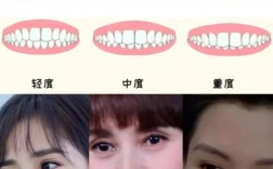 深覆合牙齿矫正到底有没有必要做？