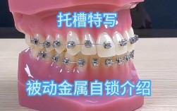 正畸托槽怎么选？哪种材质更适合你的牙齿？