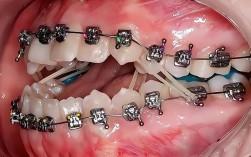 北京隐形牙齿矫正哪家好？效果如何？