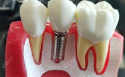 太原哪里可以做种植牙？正规医院和诊所有哪些推荐？