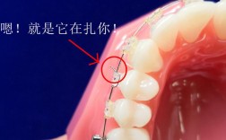 正畸上结扎丝方法