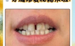 正畸后牙缝隙变大？原因何在？如何应对？