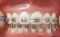 正畸方丝中点标记，如何精准定位？临床价值体现在哪？