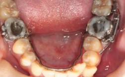 正畸 推磨牙向前