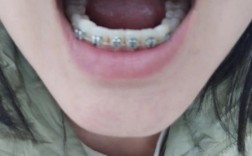 齐齐哈尔偏颌正畸