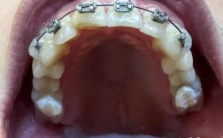 徐汇牙防所牙齿矫正效果如何？值得信赖吗？