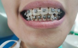 正畸矫正时给牙齿上托槽一般需要多久？单次操作耗时多久？不同牙齿拥挤程度会影响上托槽时间吗？