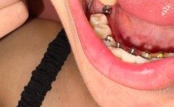 矫正托槽掉了要紧吗？该怎么紧急处理？