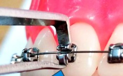 矫正牙齿托槽的位置为何对矫正效果至关重要？