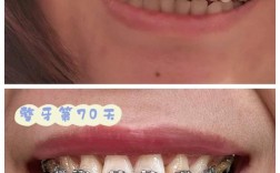 牙齿矫正为何只拔一颗？一颗的拔除对矫正效果影响大吗？