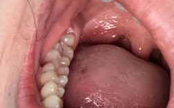 奥齿泰只植牙过敏