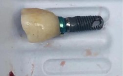 种牙一段式失败率为何居高不下？背后隐藏哪些技术风险与术后隐患？