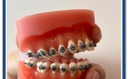 正畸三类牵引会痛吗？求解答原因和应对方法