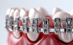 2025钢托槽矫正新进展？多久能排齐牙齿？
