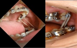 正畸牵引J钩断了怎么办？会影响矫正效果吗？