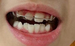 小孩正畸上门牙关闭