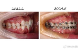 6颗牙正畸治疗
