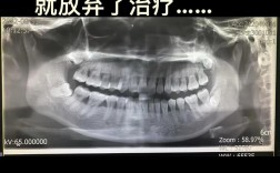 牙槽骨植骨不翻瓣，效果与优势究竟如何？