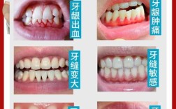 牙龈萎缩适不适合种牙？需满足哪些条件才行？