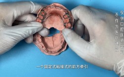 正畸牵引器正确戴法是什么？详细步骤有哪些？