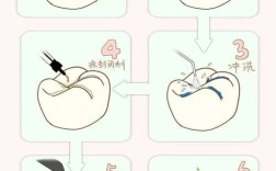 窝沟封闭剂的使用方法