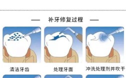 牙齿补洞的方法