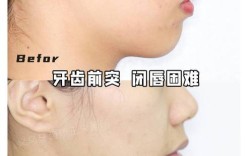 矫正牙齿真的会改变嘴型吗？具体会有哪些变化？