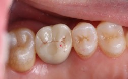 种植固定修复粘接方法