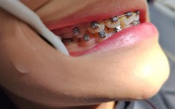 中学生矫正牙齿，家长和学生必知的矫正时机与注意事项有哪些？