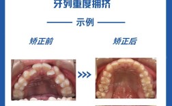 正畸牙齿拥挤的分类方法有哪些？