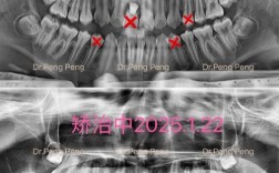 正畸压低前牙为何会导致牙根吸收？其发生机制、危险因素及临床干预策略是什么？