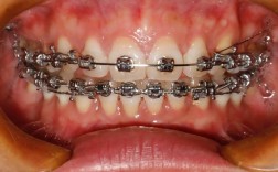 成人矫正牙齿好吗？效果、时间、风险该了解清楚？