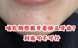 哺乳期做牙齿矫正，宝宝安全吗？