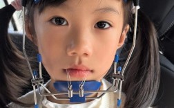 正畸前方牵引器如何正确佩戴？