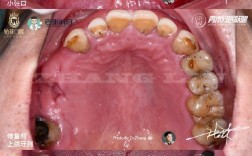 口腔咬合重建的方法有哪些？不同方法的适用情况及效果如何选择？