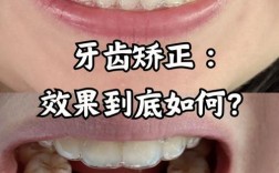 矫正与种植，哪种方案更适合你的牙齿需求？