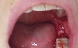 拔牙后为何要等6个月才能种牙？这段时间牙齿和牙槽床究竟在经历什么变化？