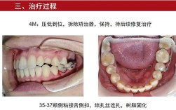 正畸磨牙为何要做？对牙齿有何影响？