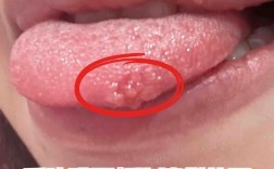 嘴里上火最快有效缓解方法有哪些？