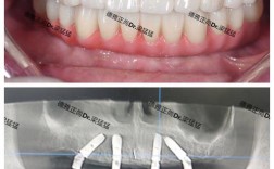 种牙种植体有哪些类型？图片大全展示不同种类。