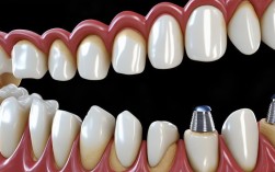 牙周炎患者能做满口种植牙吗？需先控制炎症吗？