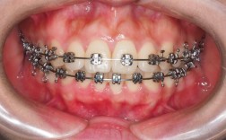 苏州成人牙齿矫正效果如何？要多久见效？