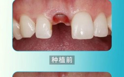 大门牙缺失后种牙好还是做烤瓷牙修复好？