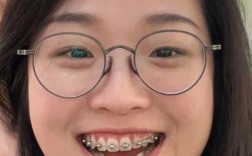 正畸自锁要换几次钢丝