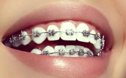 矫正牙齿托槽松了该如何处理？